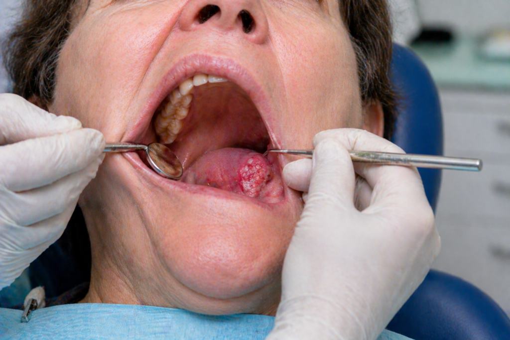 Patient atteint d'un Cancer de la bouche grave