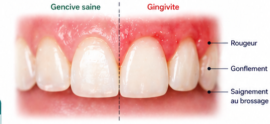 photographie d'une gencive atteinte de gingivite